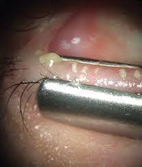 Meibomian Gland Dysfunction: Epidemiology, Pathophysiology, Diagnosis and Treatment