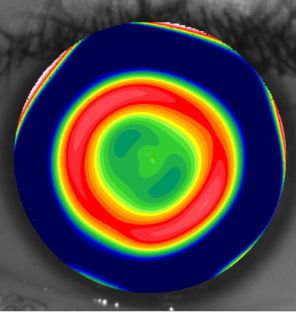 Orthokeratology Fitting and Troubleshooting