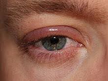 The Culprits of Blepharitis: Bacteria, Mites, and More