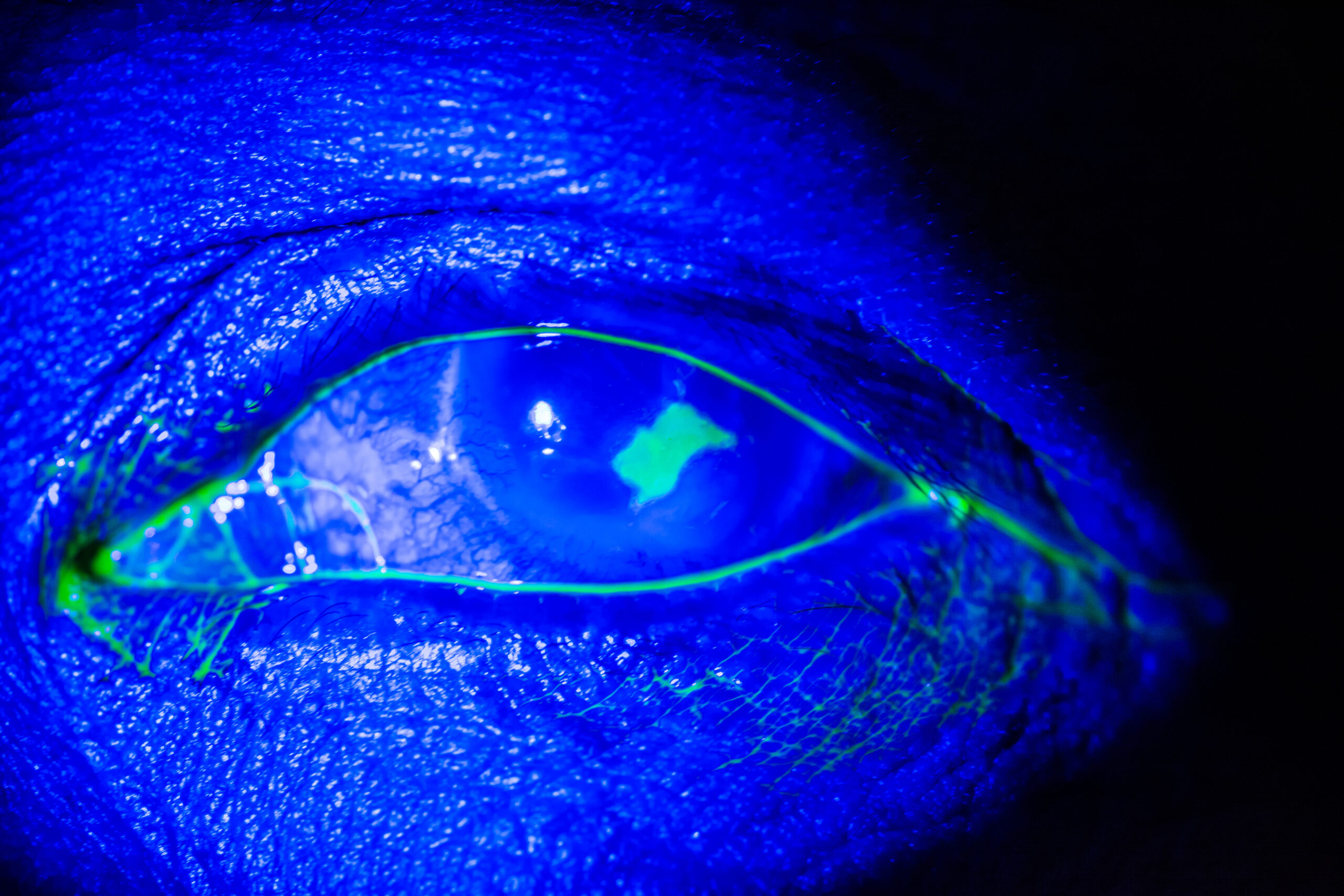 Contact Lens Complications and Resolutions