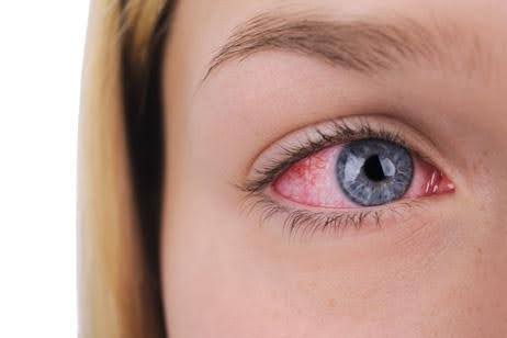 Contact Lens Complications and Resolutions