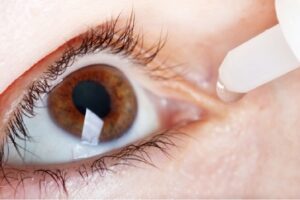Dry Eye Syndrome