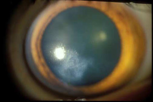 Armoring the Cone – Innovation in the Treatment of Keratoconus