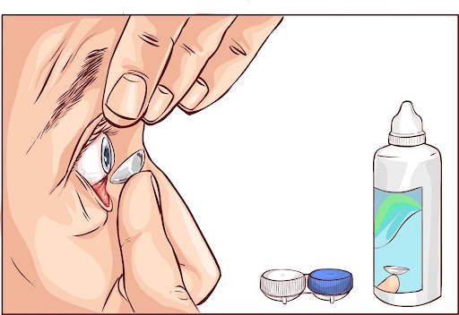 Silicone Hydrogel: A Leader in Contact Lens Technology
